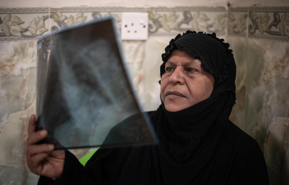 Hamida, paciente de tuberculosis resistente. Irak.