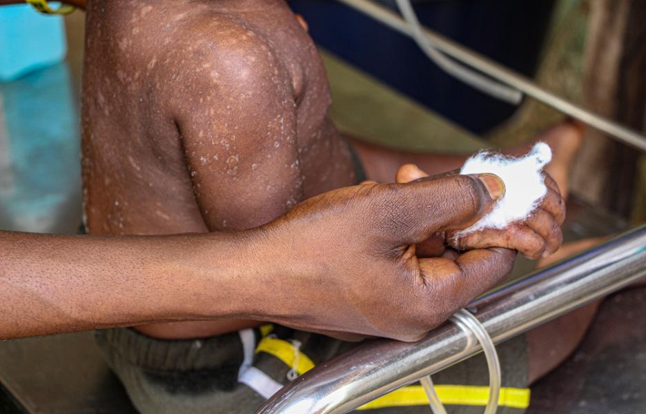 Epidemia de sarampión en Kampene