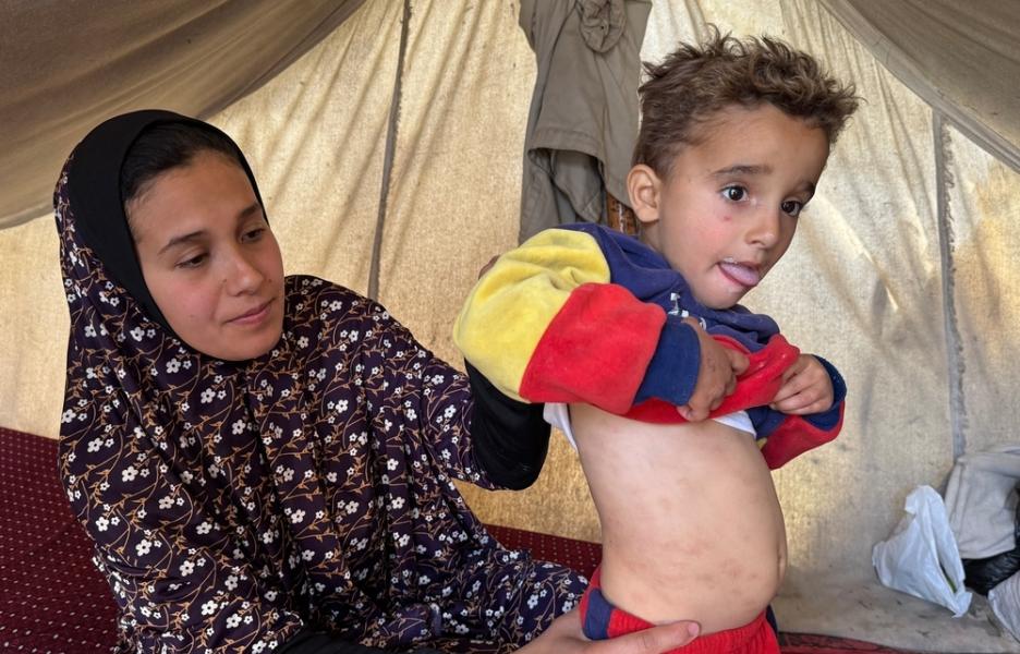 Una madre palestina muestra el estado de la piel de su hijo pequeño debido a la falta de higiene y agua limpia en Jan Yunis.
