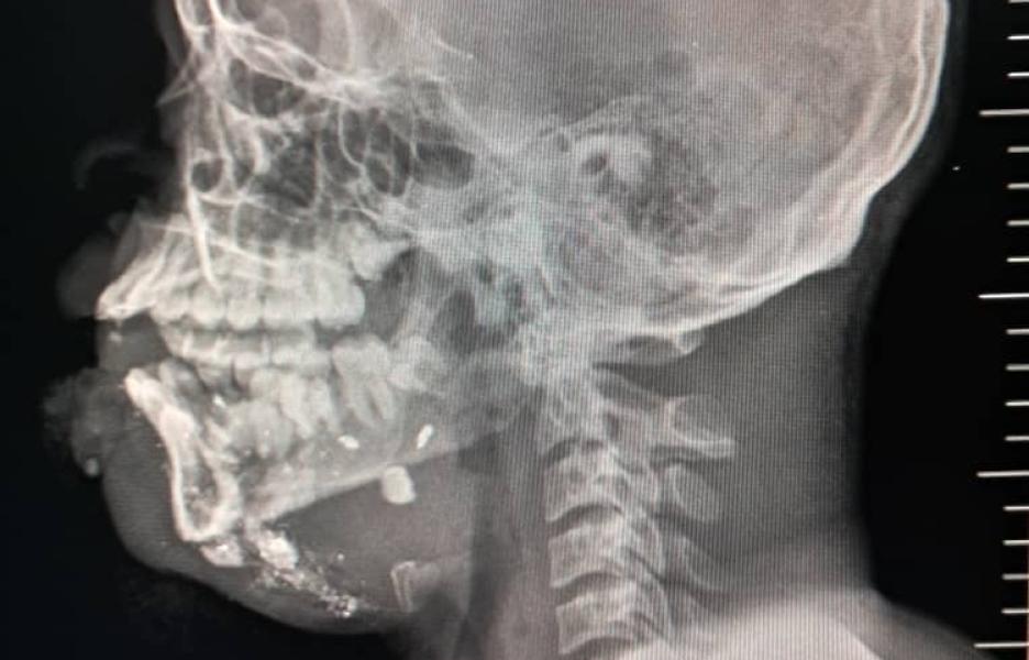 Radiografía de Patrick*, 18 años, fue alcanzado por una bala perdida cuando regresaba a casa desde la escuela.