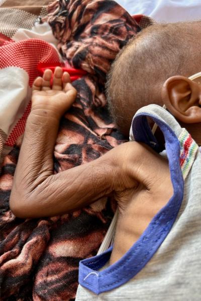 Primer plano de Abdul Mazin Mahmoud, menor de un año, con desnutrición aguda grave recibiendo atención en la unidad de cuidados intensivos de MSF en el hospital de MSF en Tawila.