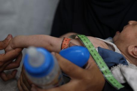 Un bebé palestino que padece desnutrición, siendo atendido en la clínica de MSF en la ciudad de Gaza.