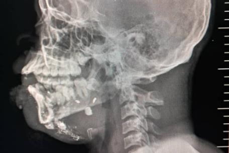Radiografía de Patrick*, 18 años, fue alcanzado por una bala perdida cuando regresaba a casa desde la escuela.