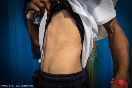Un hombre muestra una cicatriz que le infligieron en Libia a bordo del Aquarius tras ser rescatado.