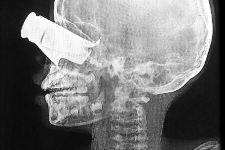 Radiografía de un niño con herida de metralla.