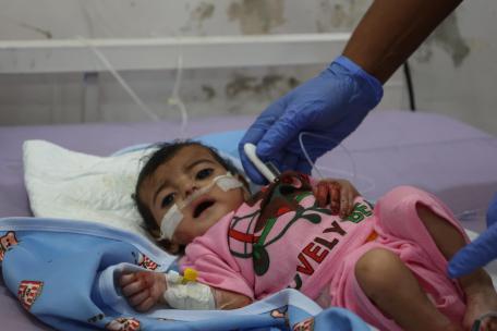 Niño ingresado en el Centro de Alimentación Terapéutica del Hospital General de Abs, que cuenta con el apoyo de MSF. Se le diagnosticó desnutrición aguda grave y actualmente está recibiendo tratamiento.