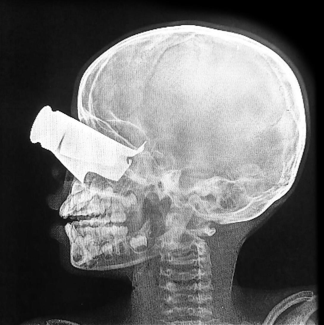 Radiografía de un niño con herida de metralla