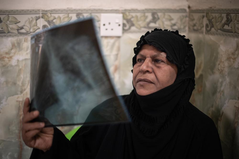 Hameeda de 65 años, mira una radiografía de sus pulmones. Es la primera paciente en Irak curada con un tratamiento oral de tuberculosis resistente a los medicamentos.